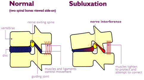 Lumbar Subluxation
