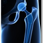 Avoid Joint Replacements