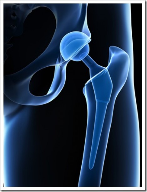 Avoid Joint Replacements